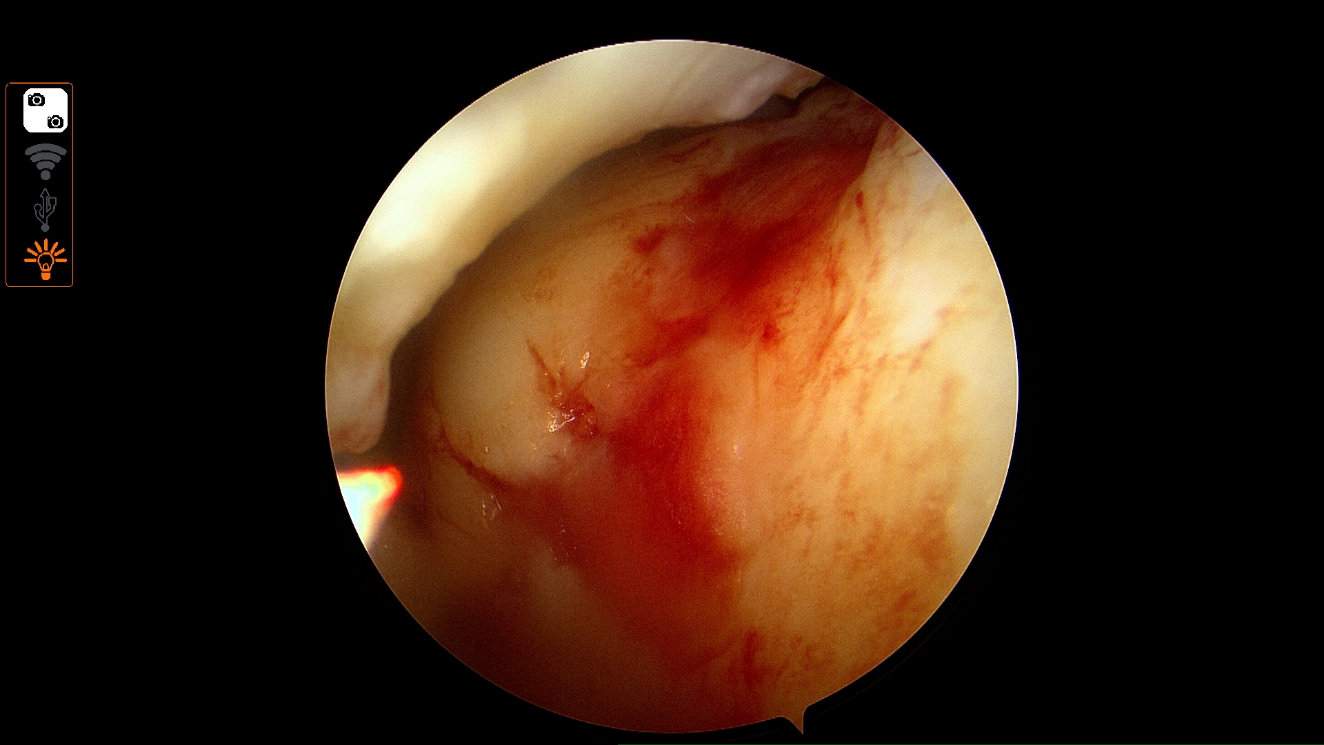 ACL condition
