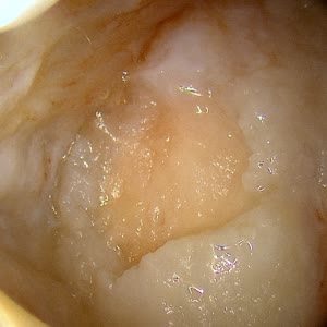 Arthroscopic view of worn knee cartilage