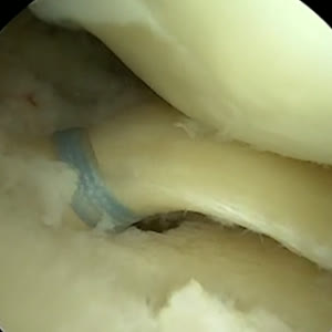 Arthroscopic view of a meniscus repair